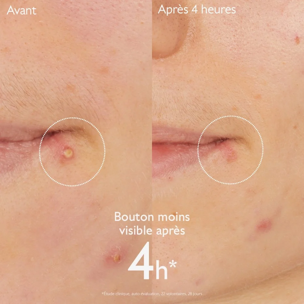 CAUDALIE VINOPURE - STOP BOUTONS SALICYLIQUE 15ML