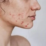 Peaux acnéiques